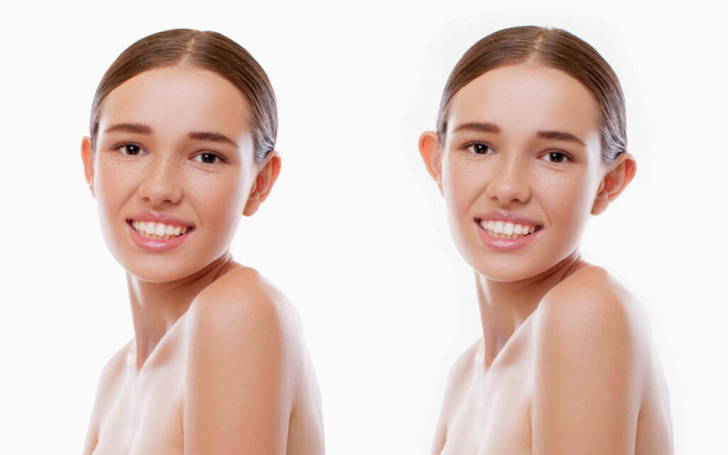 Ωτοπλαστική – Αποκαταστήστε το σχήμα των αυτιών με φυσικότητα και διακριτικότητα